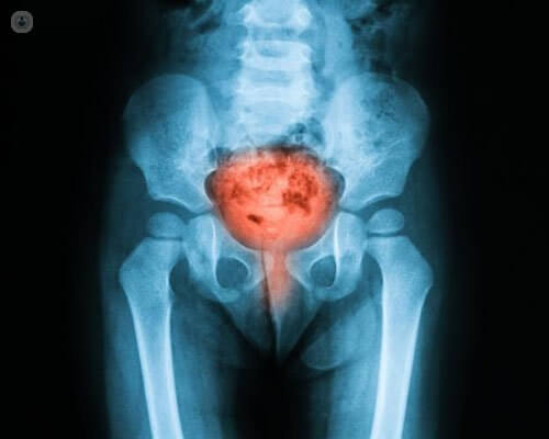 علائم ابتلا به التهاب مثانه